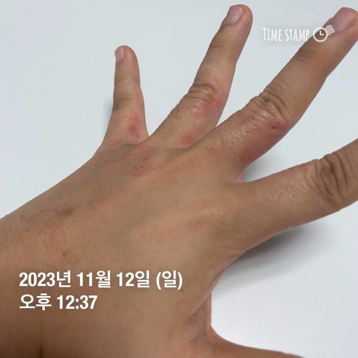 한포진 20대 여성