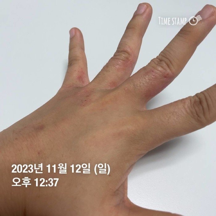 한포진 20대 여성