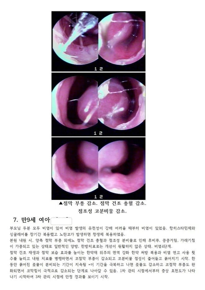 면역 건조성 찐득한 농성콧물 코피 킁킁거리는 후비루 동반한 비염 만9세 아이
