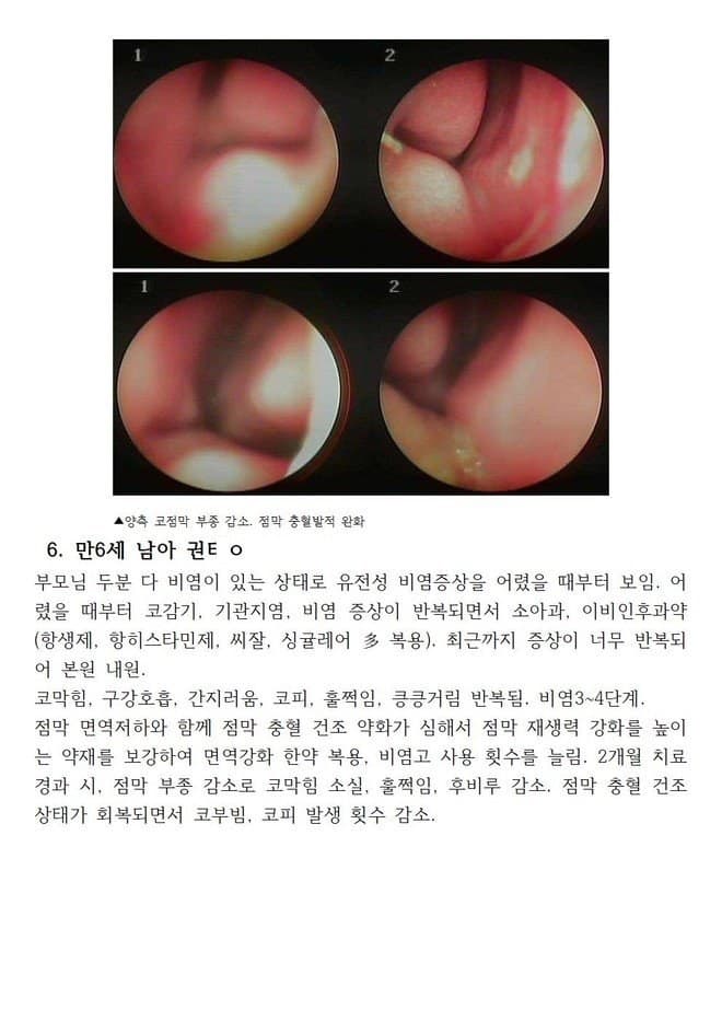 면역 만6세 비염으로 코점막 충혈이 심해 코피 재채기 코막힘이 반복되었던 아이