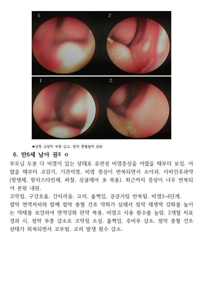 면역 만6세 비염으로 코점막 충혈이 심해 코피 재채기 코막힘이 반복되었던 아이