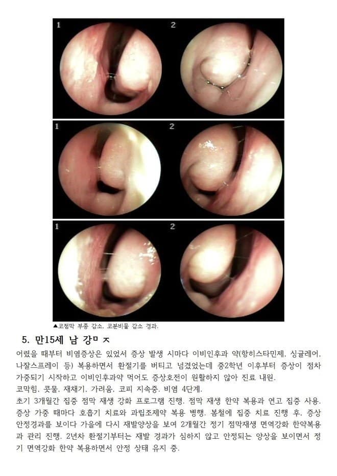 면역 만15세 콧물 코막힘 코피 반복으로 양약 복용이 반복되었던 아이