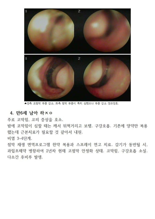면역 알레르기 비염으로 점막부종과 점막충혈건조 손상으로 코피 코막힘이 반복되는 만6세 아이